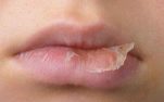 Xử lý môi khô khi giao mùa